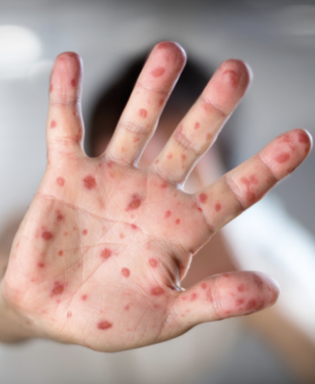 Rujeola face ravagii: 24 de copii au murit în România iar Guvernul preocupat de TVA și reorganizare